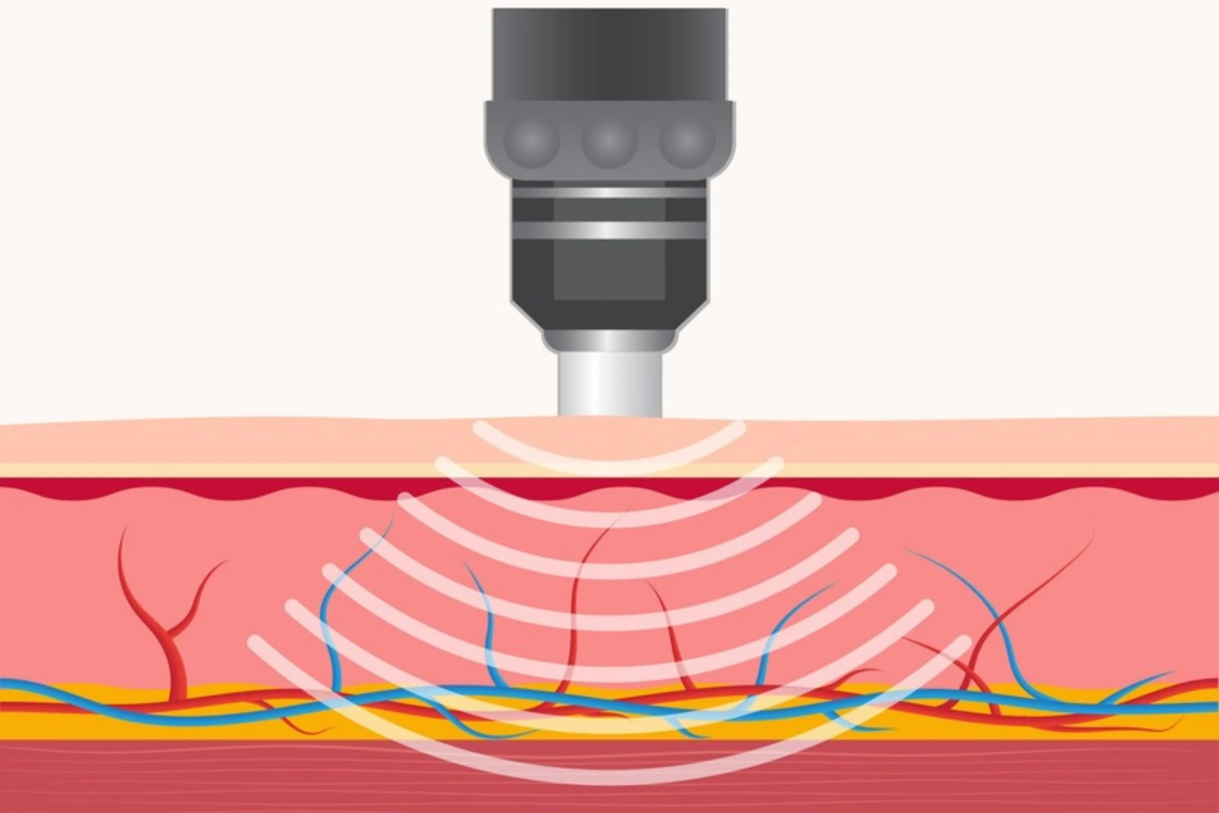 Shockwave therapy